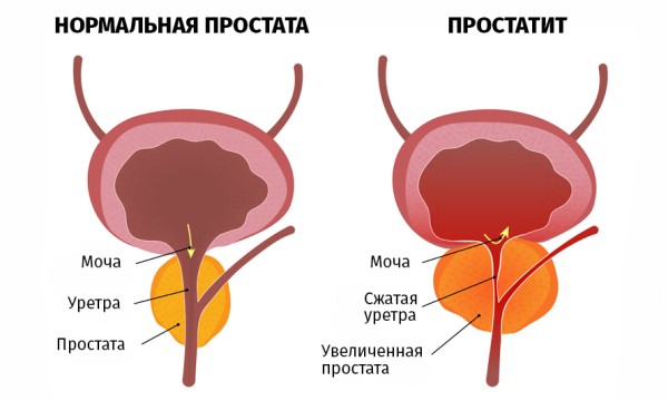 Топ-5 народных средств для лечения простатита в домашних условиях