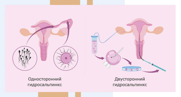 Гидросальпинкс лечение без операции