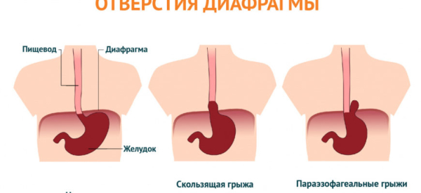 Причины появления кома в горле при гастрите