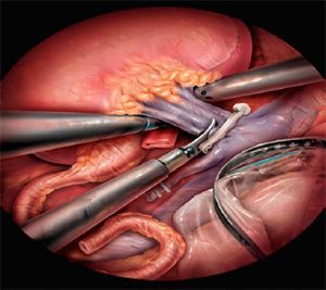 Удаление почки посредством лапароскопического метода