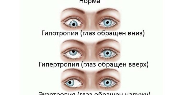 Страбизм: можно ли исправить косоглазие у взрослых