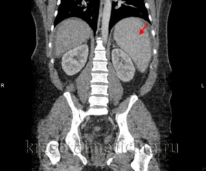 Спленомегалия: критерии, причины, проявления, диагностика, лечение
