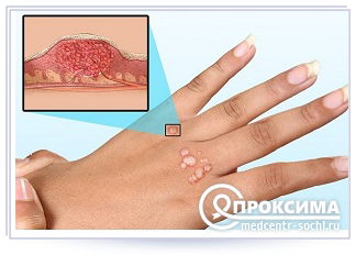 Причины, симптомы и лечение бородавок на лице