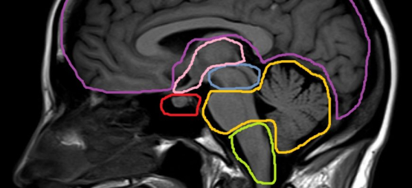Анатомия цистерн головного мозга