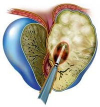 Простатит у детей &mdash; причины, симптомы, лечение и профилактика