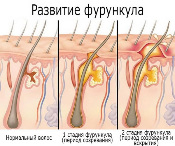 Не выходит стержень фурункула &mdash; что делать?