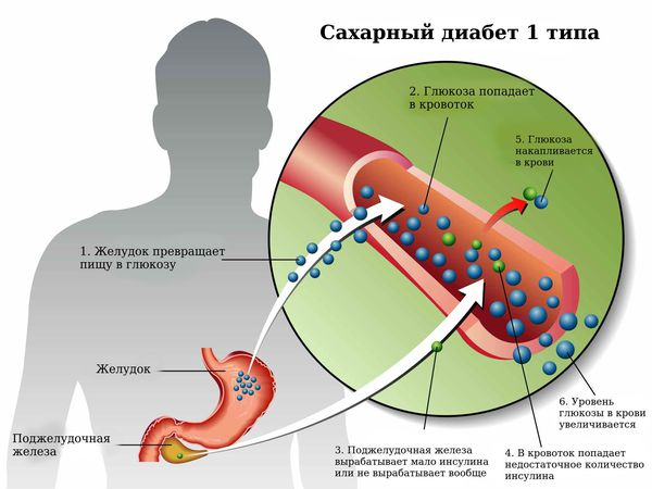 Передозировка инсулина: последствия, может ли наступить смерть