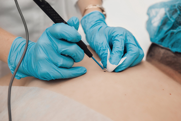 Радиоволновой метод удаления папиллом