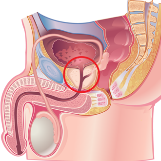 Простаторея у мужчин &mdash; симптомы и лечение, профилактика