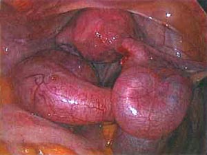 Гидросальпинкс лечение без операции