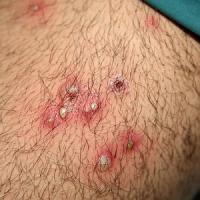 Стафилококковый фолликулит: что это такое и как его лечить