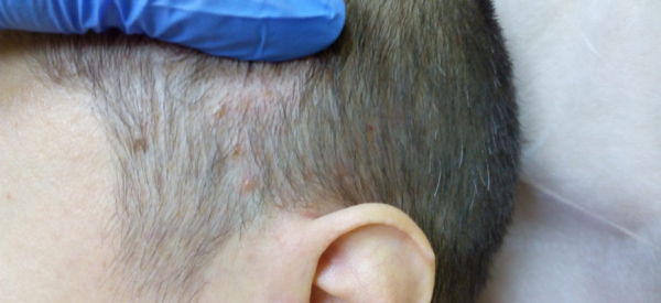 Бородавки на голове ребенка: причины, симптомы и лечение