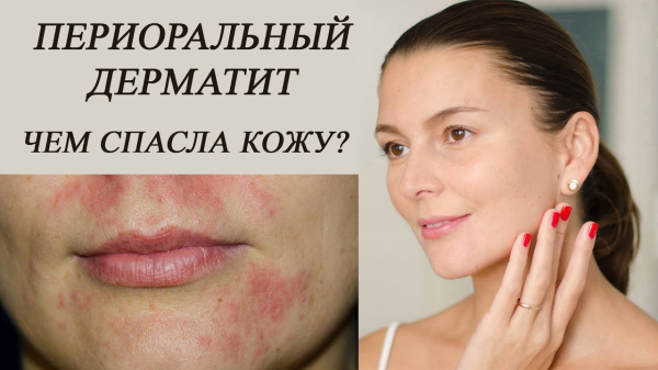 Способы лечения периорального дерматита у взрослых и детей