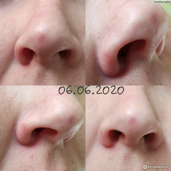 Как избавиться от папиллом на носу?