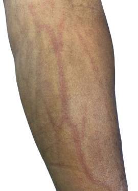 Лечение постинъекционного флебита вены на руке