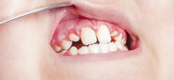 Стоматит у детей: причины, симптомы, диагностика, лечение