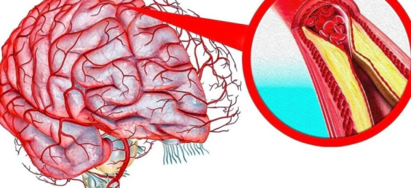 Атеросклеротическая болезнь сердца: симптомы, лечение, причина смерти