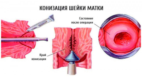 Конизация шейки матки: процедура, показания и последствия