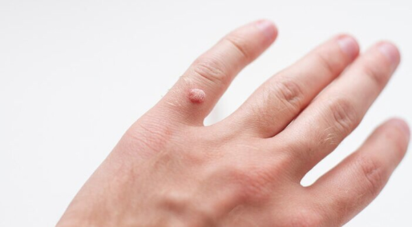 Бородавки на голове ребенка: причины, симптомы и лечение