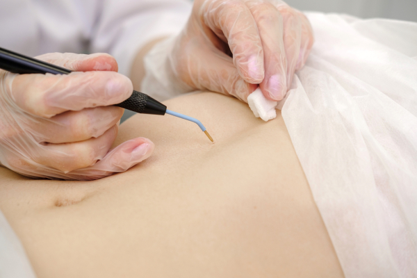 Уход за раной после операции по удалению папилломы