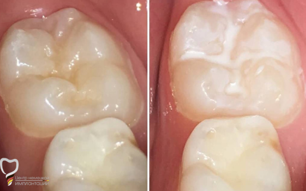 Герметизация фиссур зубов у детей и взрослых: что это, за и против
