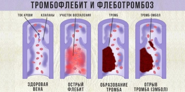 Лечение постинъекционного флебита вены на руке