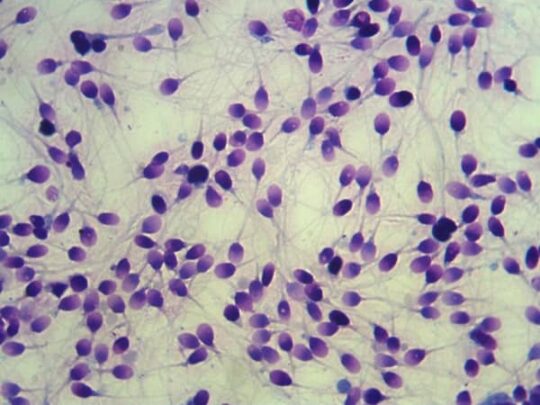 Обнаружена агрегация сперматозоидов: причины и действия