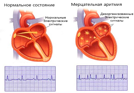 Связь остеохондроза и аритмии: причины, диагностика, лечение