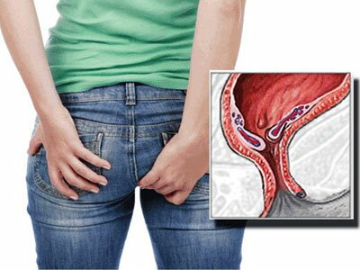 Жжение в заднем проходе: 15 причин жгучего дискомфорта, лечение