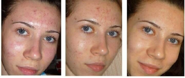 Можно ли удалить папилломы Дарсонвалем?