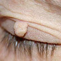 Бородавка и папиллома: основные отличия