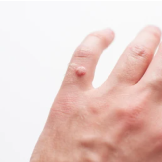 Что такое вирусная бородавка: симптомы и лечение