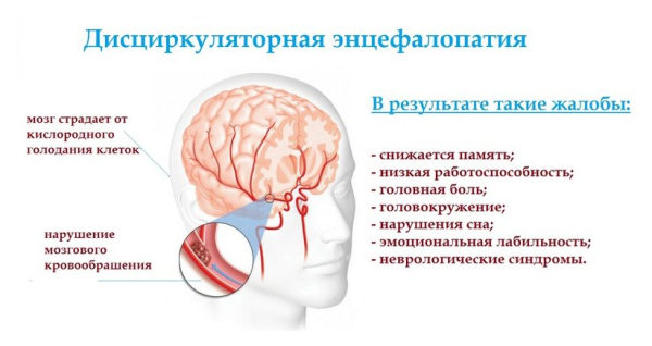 Дисциркуляторная энцефалопатия (ДЭП): развитие и диагноз, симптомы и стадии, терапия