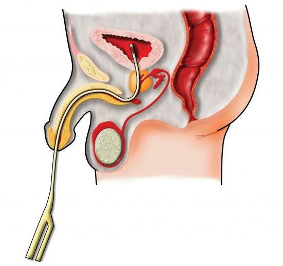 Спинальная импотенция: причины, симптомы и методы лечения