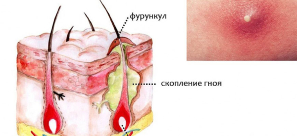 Не выходит стержень фурункула &mdash; что делать?