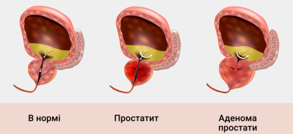 Лечение простатита и аденомы простаты луковой шелухой у мужчин