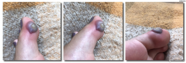 Как и сколько заживает бородавка после удаления азотом