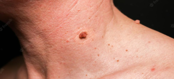 Как правильно лечить воспаленную папиллому на шее?