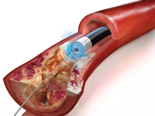 Реканализация тромба (вен, артерий): механизм, виды и способы