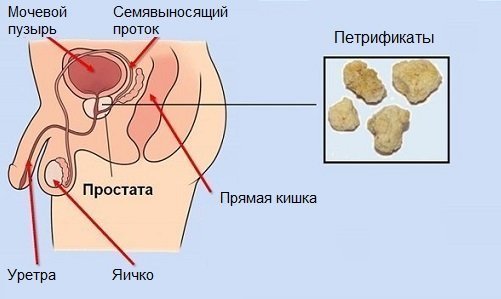 Лечение импотенции у мужчин народными средствами