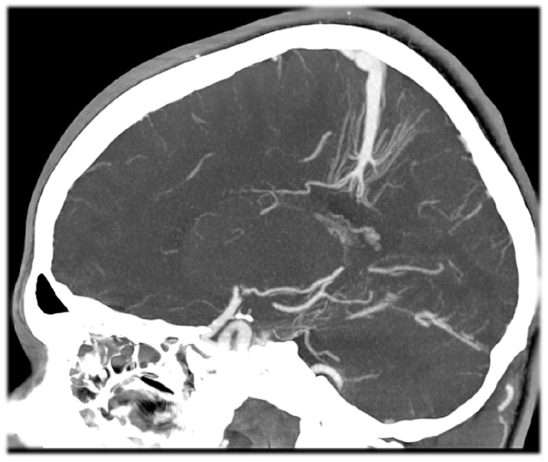 Что такое венозная ангиома головного мозга: причины, лечение, прогноз
