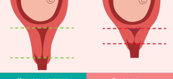 Как понять, что шейка матки укорочена