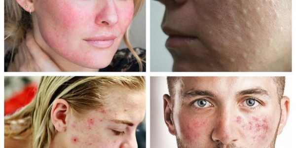 Лечение паразитов на лице человека