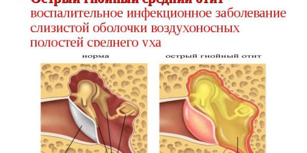 У ребенка стреляет ухо: что делать, чем лечить