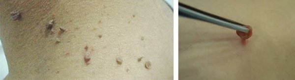 Как правильно лечить воспаленную папиллому на шее?