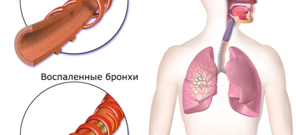 Боль в грудине справа: причины у женщин, мужчин