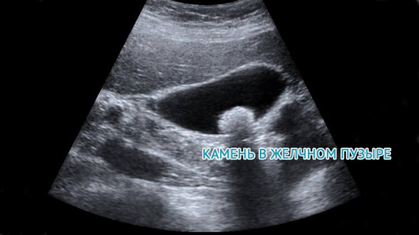 УЗИ желчного пузыря и печени