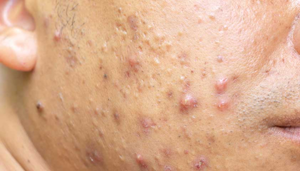 Лечение паразитов на лице человека