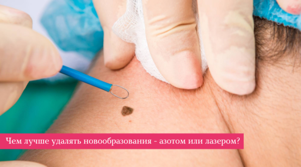 Удаление бородавки жидким азотом: последствия процедуры