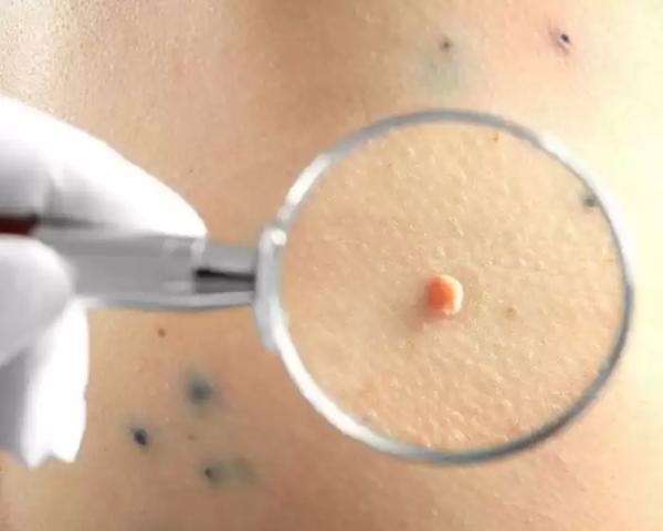 К какому врачу обратиться при папилломах